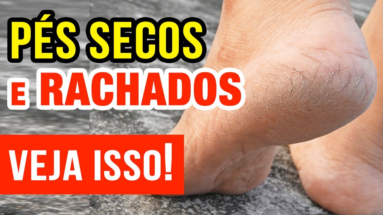 Tem PÉS SECOS e RACHADOS? Você precisa VER ISSO!