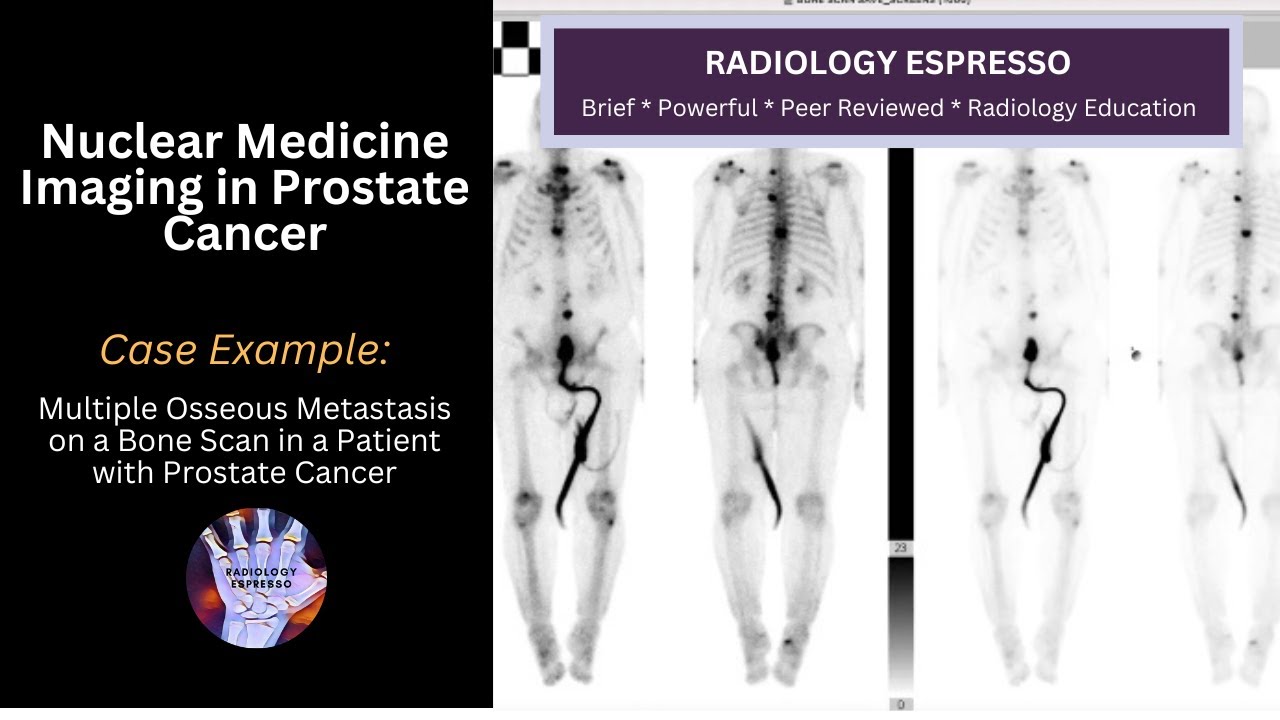 NUCLEAR MEDICINE IMAGING IN PROSTATE CANCER: Case Example –Multiple Osseous Metastasis on Bone Scan