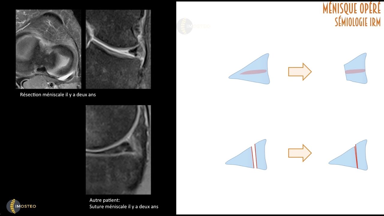 TUTORIEL IMOSTEO # 19 : Fissurations méniscales- Aspects post-opératoires
