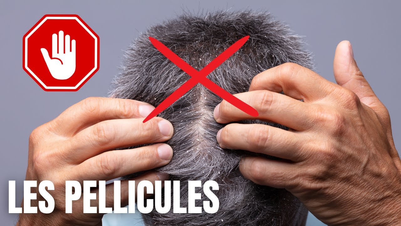 Les Pellicules; Comment s'en Débarrasser?