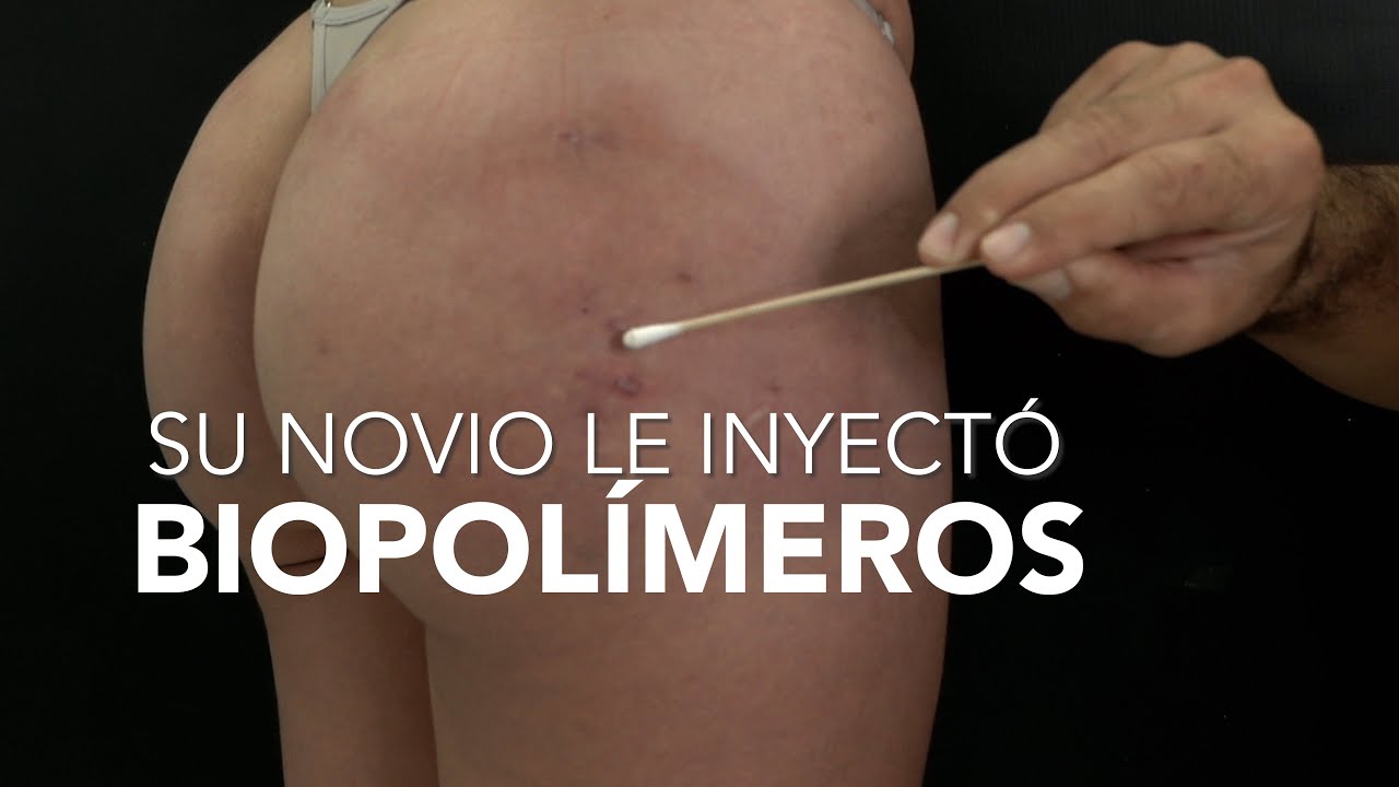 El novio le inyectó biopolímeros y grasa de otra persona