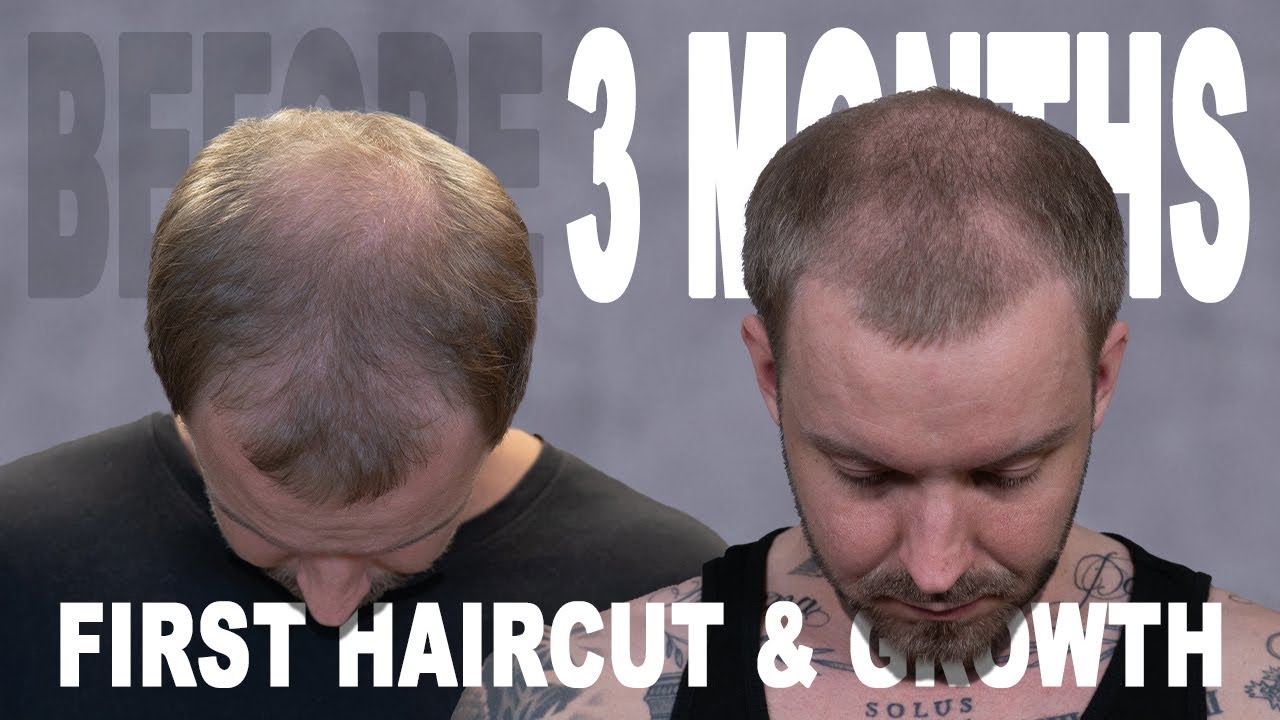 3 MONTHS | HAIR TRANSPLANT | COSMEDICA CLINIC