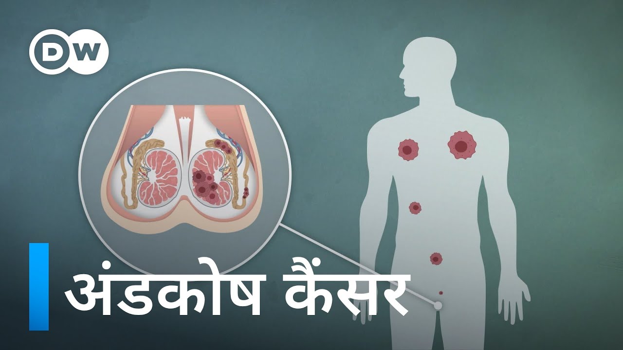 नौजवान पुरुषों को अंडकोष कैंसर का खतरा [Testicular cancer – a risk for young men]