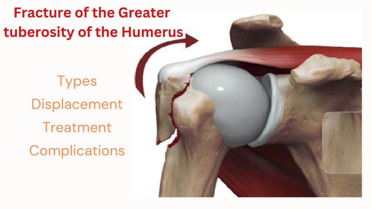 FRACTURE OF THE GREARTER TUBEROSITY OF THE HUMERUS | DISPLACEMENT, TREATMENT & COMPLICATIONS