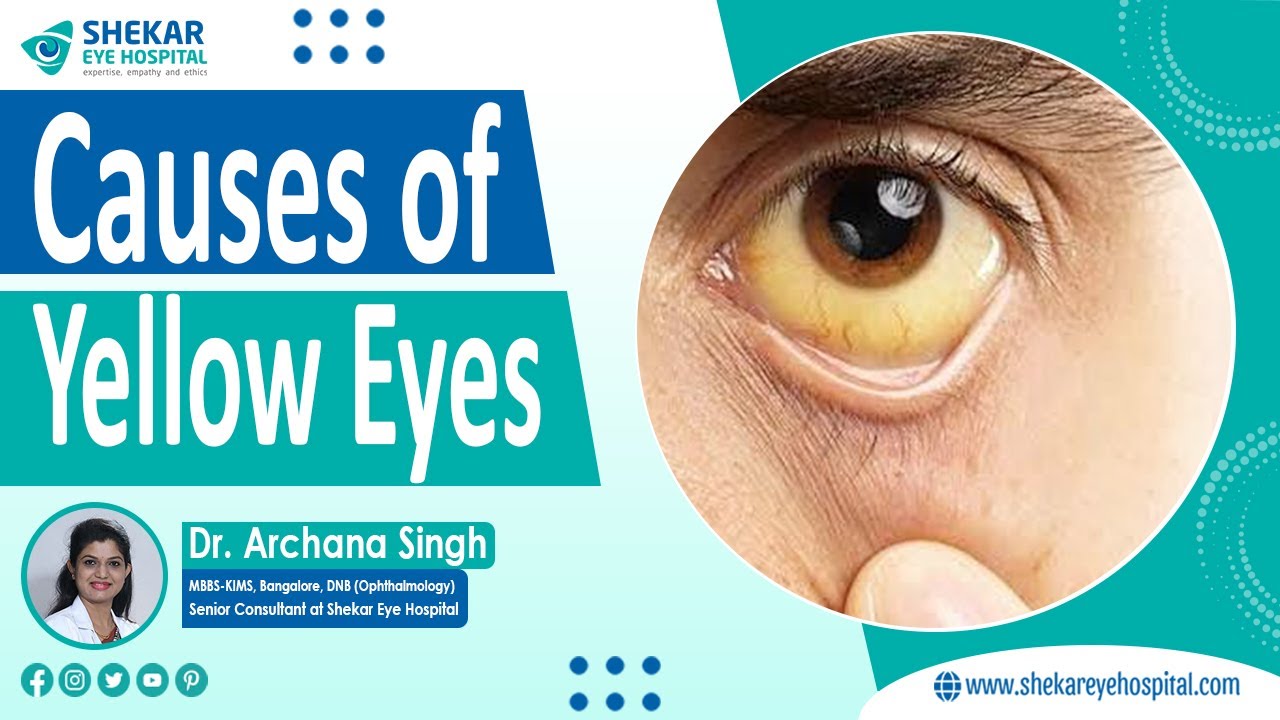 Causes of Yellow Eyes | Yellow Eyes Treatment in Bangalore | Shekar Eye Hospital