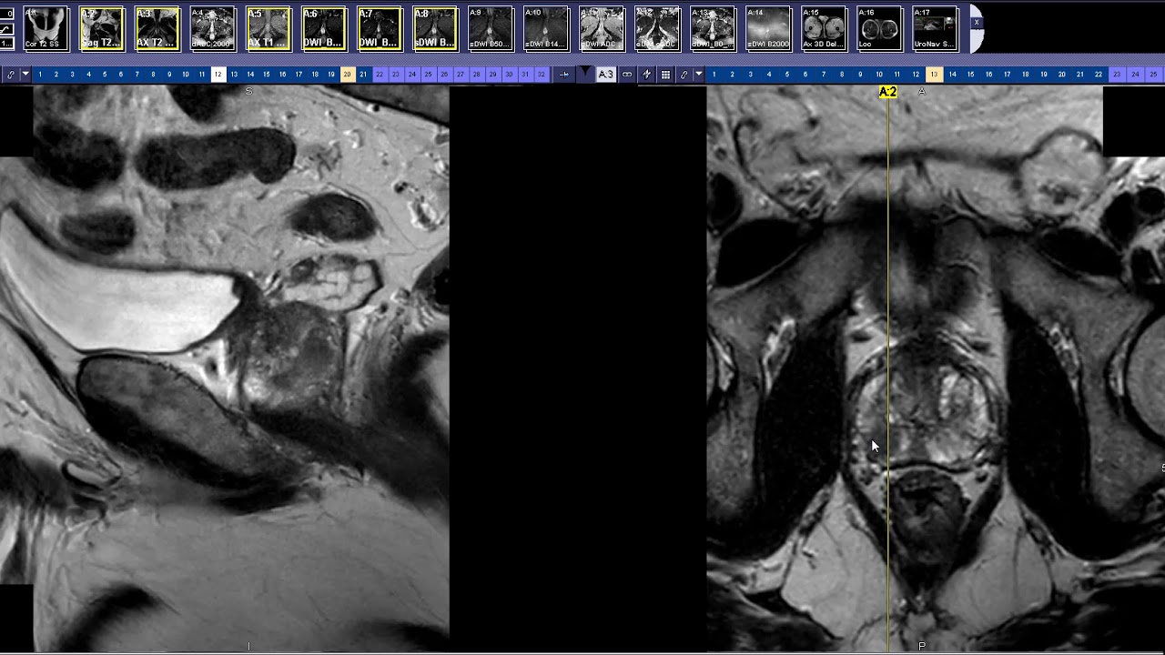 How to read a Prostate MRI