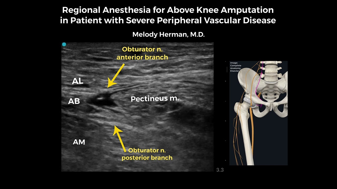 Regional Anesthesia for Above Knee Amputation in Patient with Severe Peripheral Vascular Disease