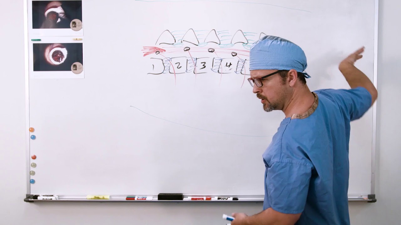 Why MIS-TLIF Spine Surgery is Needed | Post Operation | Transforaminal Lumbar Interbody Fusion