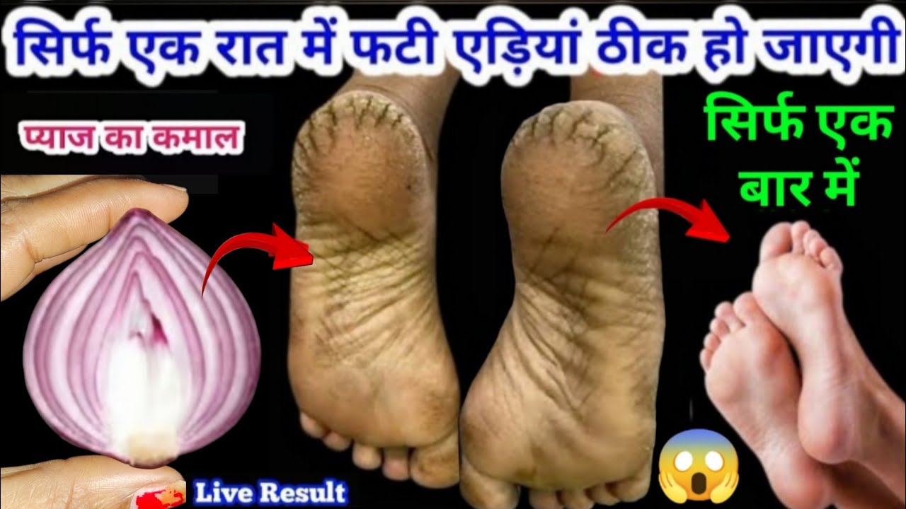 गारंटी है! 1 ही रात में ठीक हो जाएंगी फटी एड़ियांये जादुई उपाय एड़ी सॉफ्ट-मुलायम करेगा 😱Cracked Heels