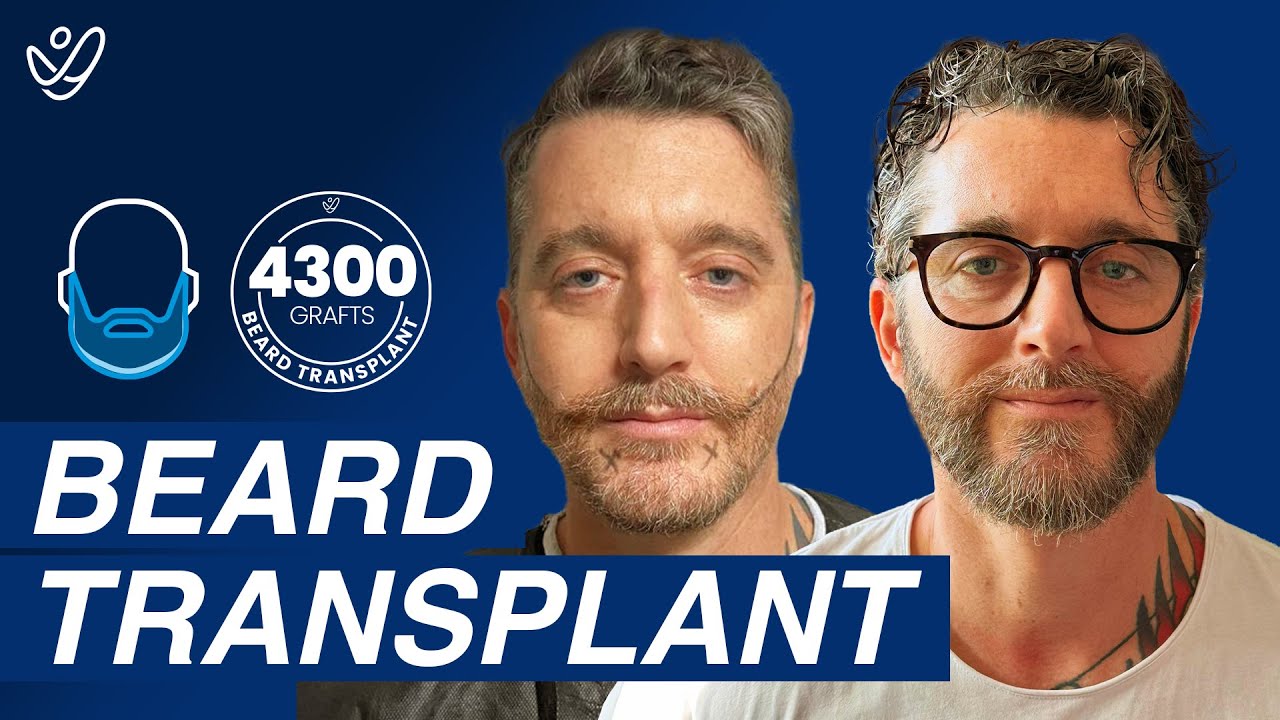 Beard Transplant Journey: 4300 Graft Before And After | Up To 18 Months