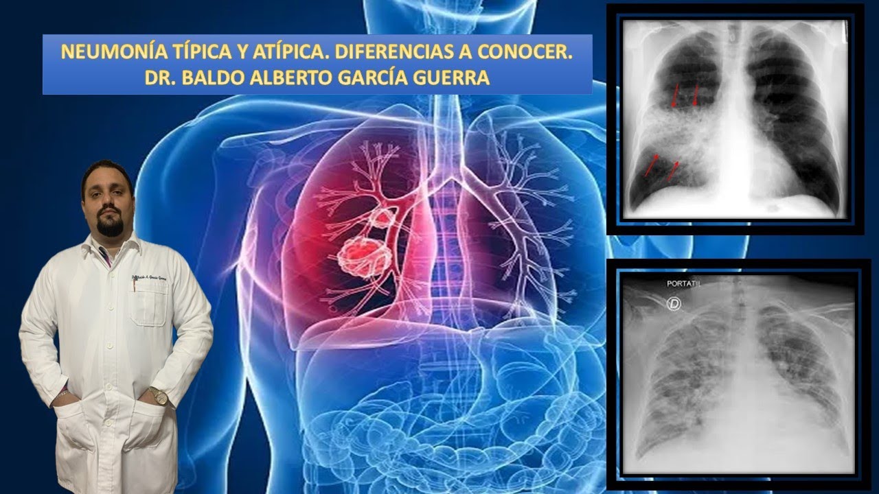 NEUMONÍA TÍPICA Y ATÍPICA. DIFERENCIAS A DESTACAR.