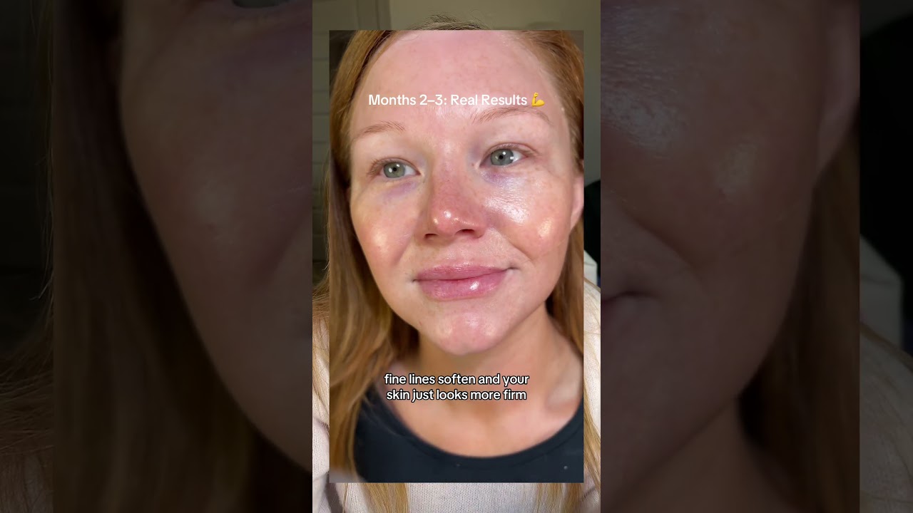 Microneedle results timeline #microneedling