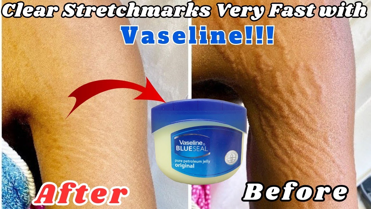 Remove STRETCH MARKS Fast with 4 NATURAL Ingredients! | Vaseline, Honey, Coconut Oil & Aloe Vera
