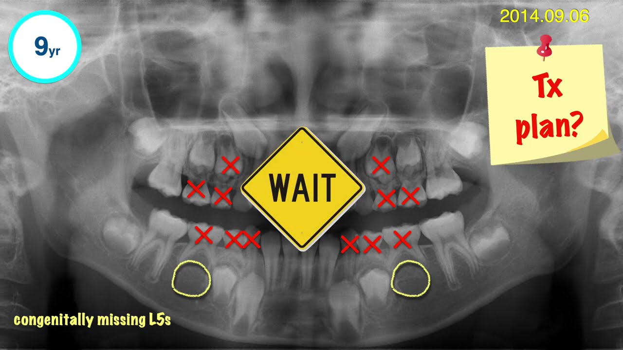 Class III + Functional Shift + Congenital Missing L5s｜【Chris Chang Ortho】CC712