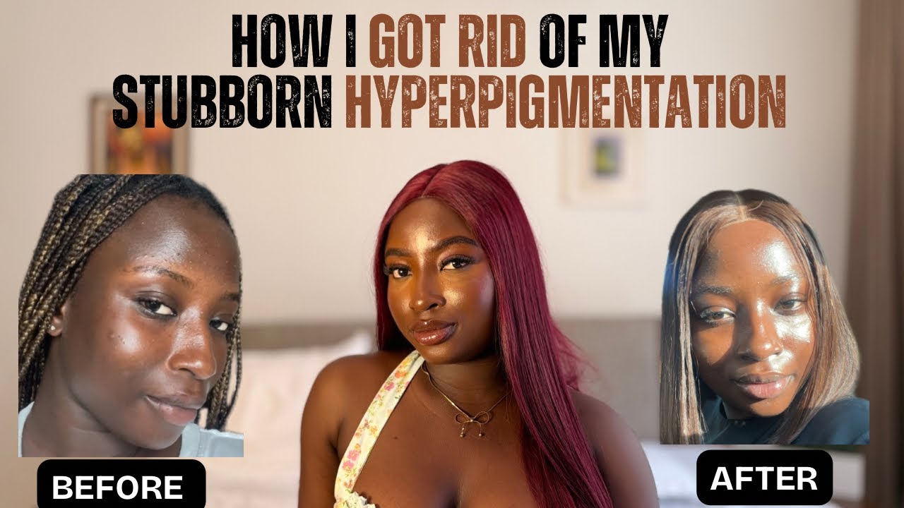 HOW I GOT RID OF MY HYPERPIGMENTATION| DARK SPOTS| SUNBURN| MELASMA| SKINCARE ROUTINE FOR CLEAR SKIN