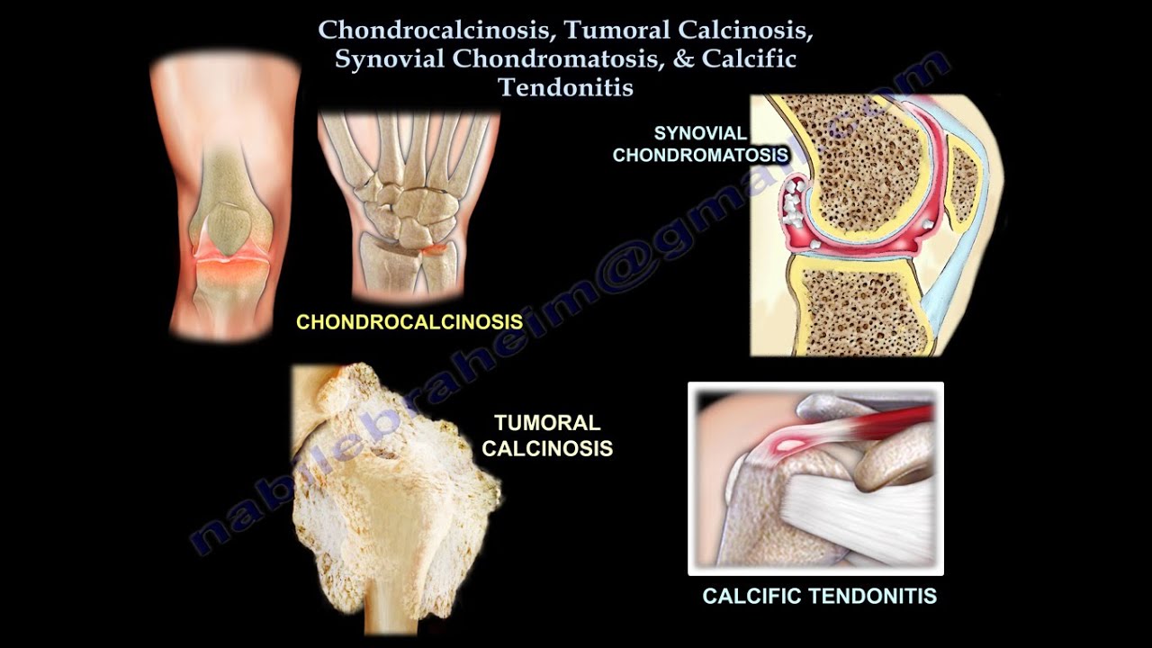 Chondrocalcinosis, Tumoral Calcinosis, synovial chondromatosis and calcific tendonitis