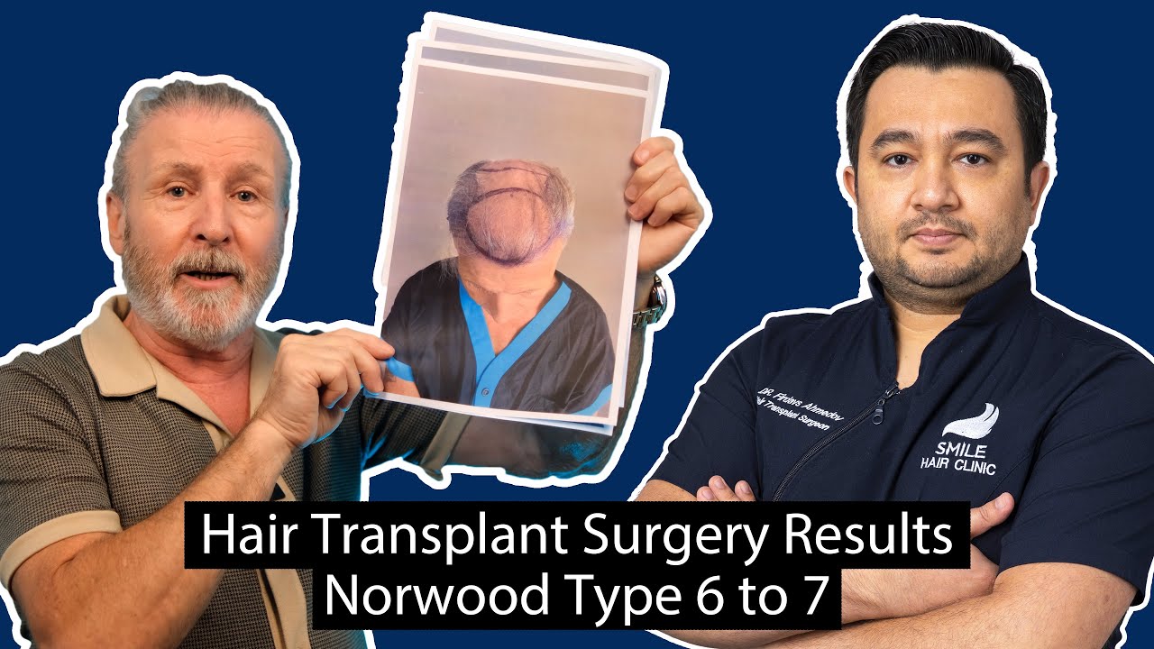 Hair Transplant Surgery Results for Norwood Type 6 to 7