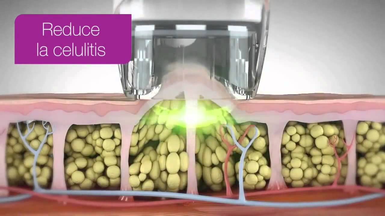 Velashape 3 - RO Medical Art