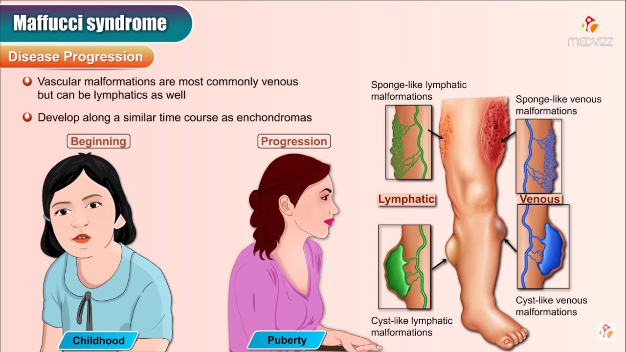 Maffucci's syndrome - Animation