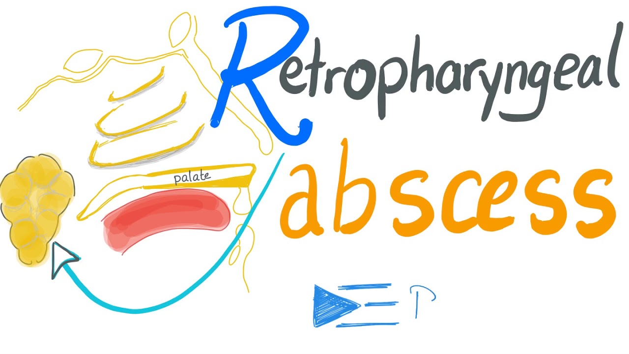 Retropharyngeal Abscess