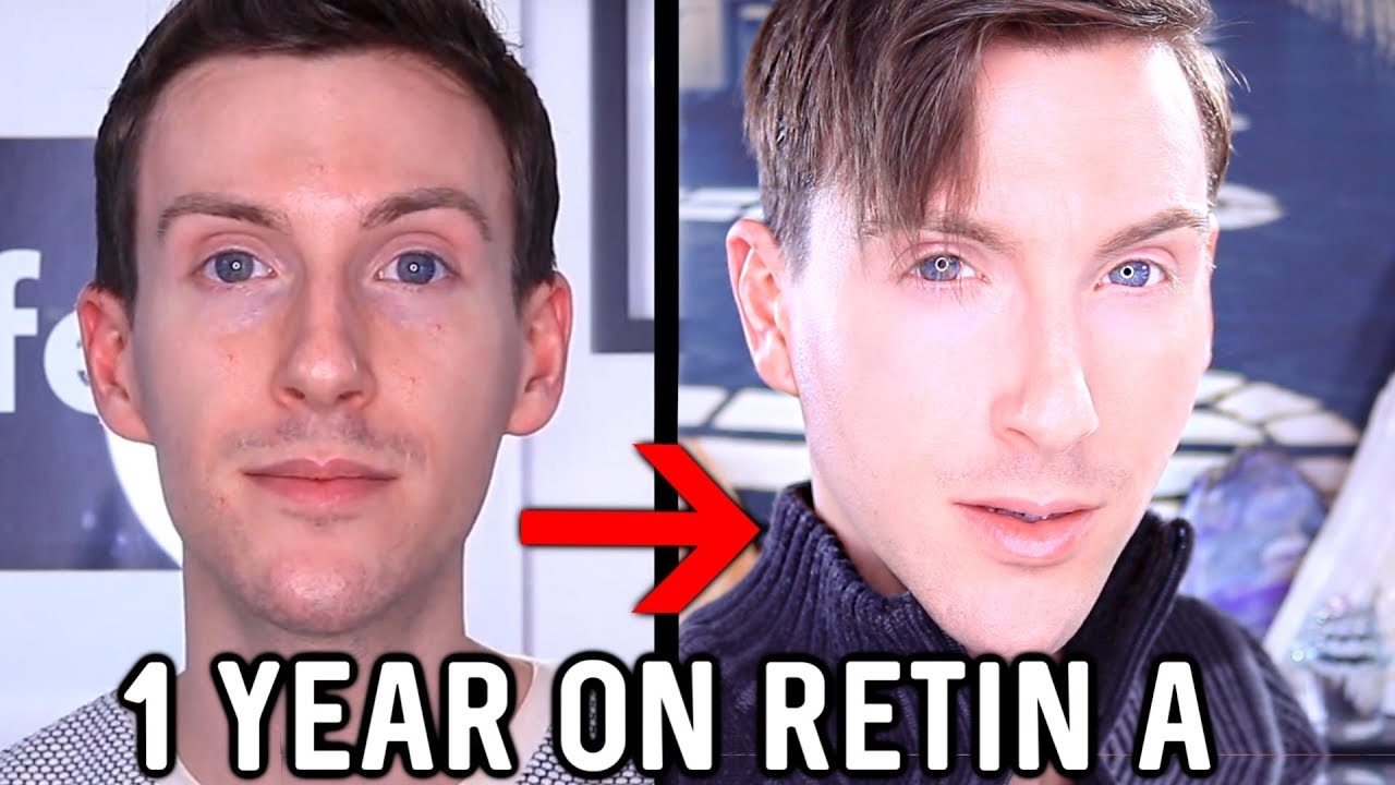 MY 1 YEAR RETIN-A RESULTS | BEFORE AND AFTER TRETINOIN