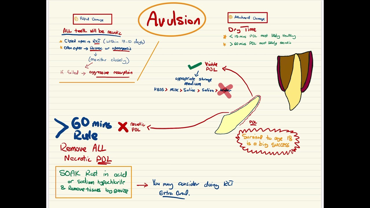 Avulsion  مختصر لكيفيه التعامل مع سقوط الأسنان الدائمه
