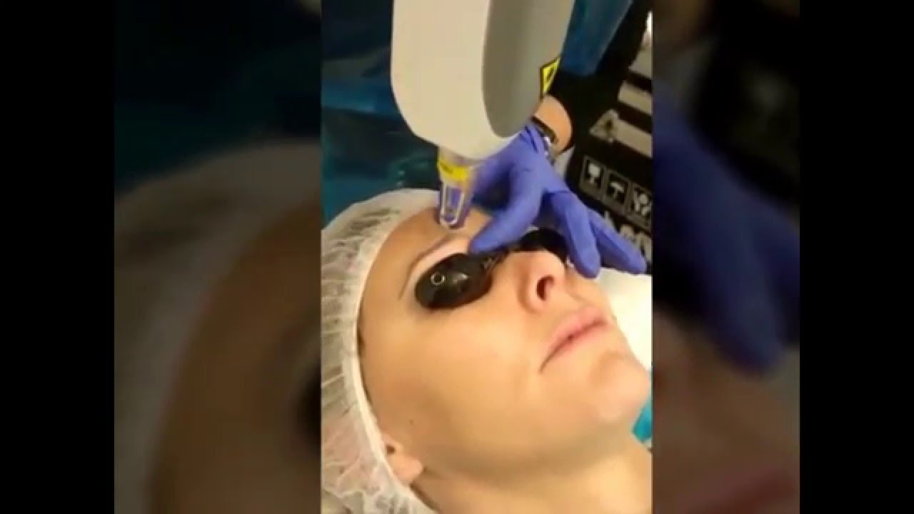Eyebrow Tattoo Removal (Permanent Makeup) Before and After