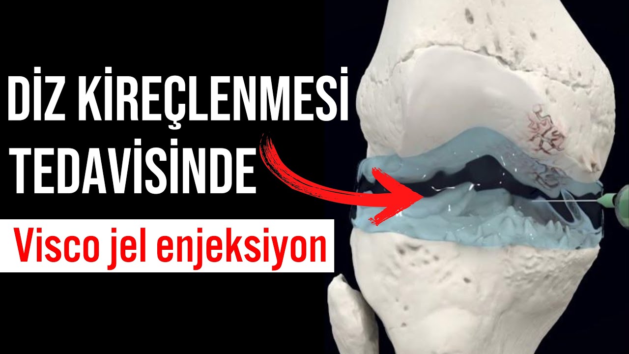 Diz kireçlenmesine ne iyi gelir ! Dizde Sıvı Kaybı DİZ KİREÇLENMESİ TEDAVİSİ İğne Yapılması