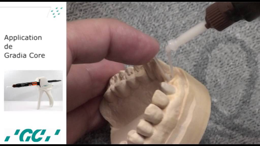 Réalisation Inlay Core esthétique avec Gradia Core #2