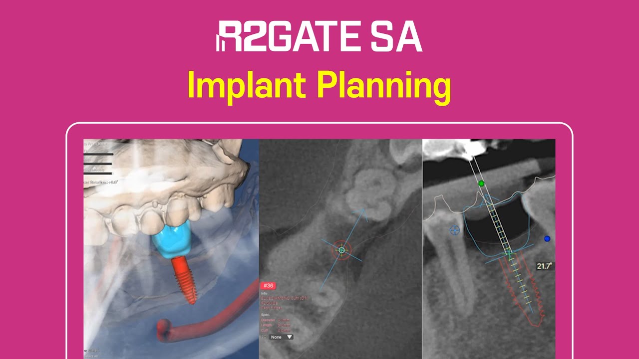 R2GATE SA Tutorial Series | Step 6: Implant Planning🎯