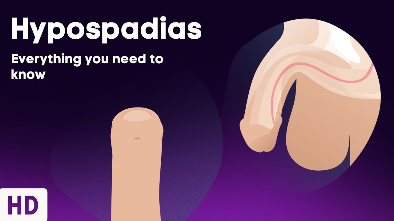 Hypospadias: Everything You Need To Know