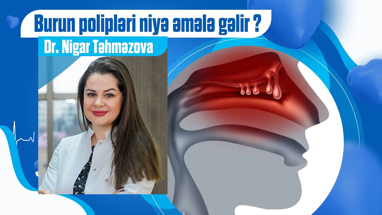 Burunda poliplər niyə əmələ gəlir və onları necə müalicə etmək lazımdır?