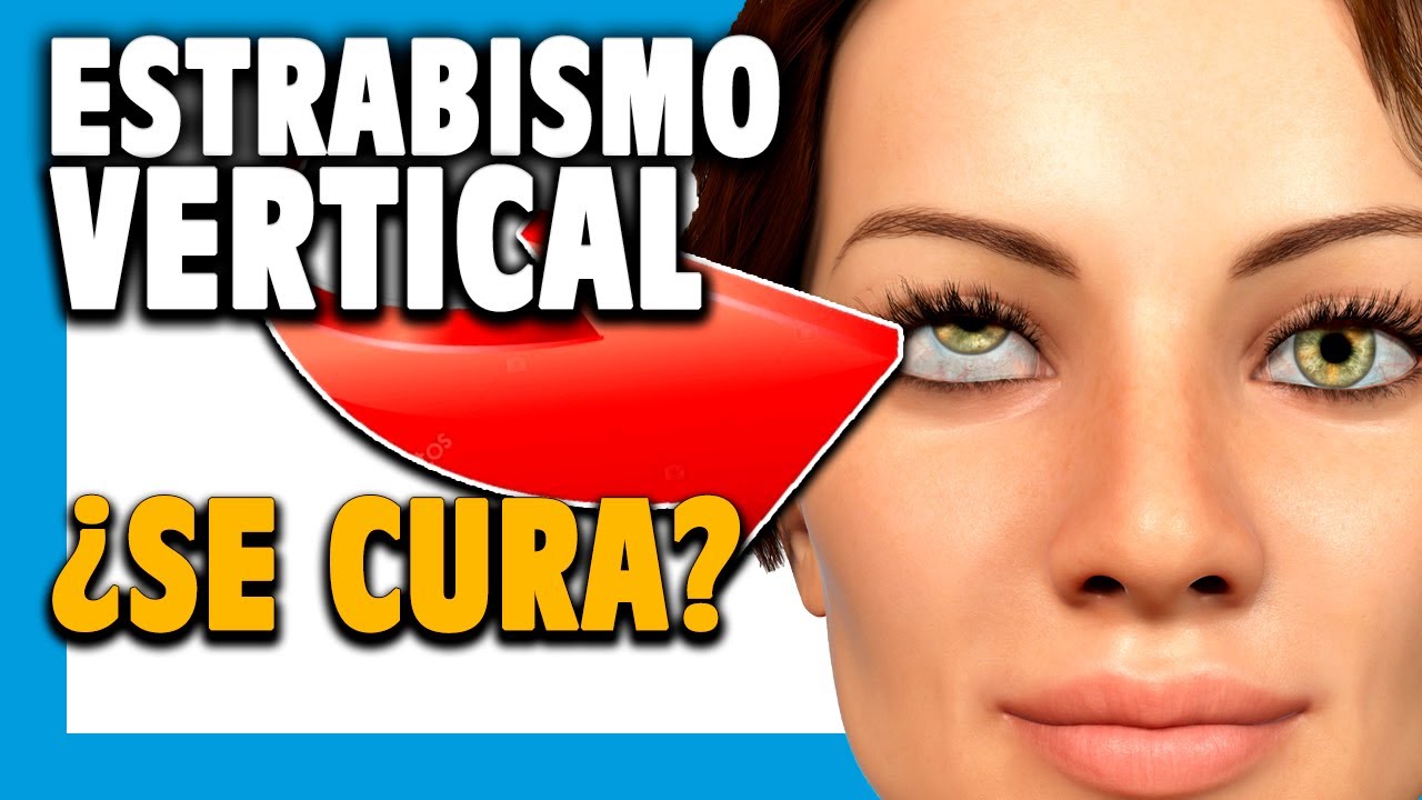 ¿Curar el ESTRABISMO VERTICAL? Todo sobre la HIPERTROPIA e HIPOTROPIA.