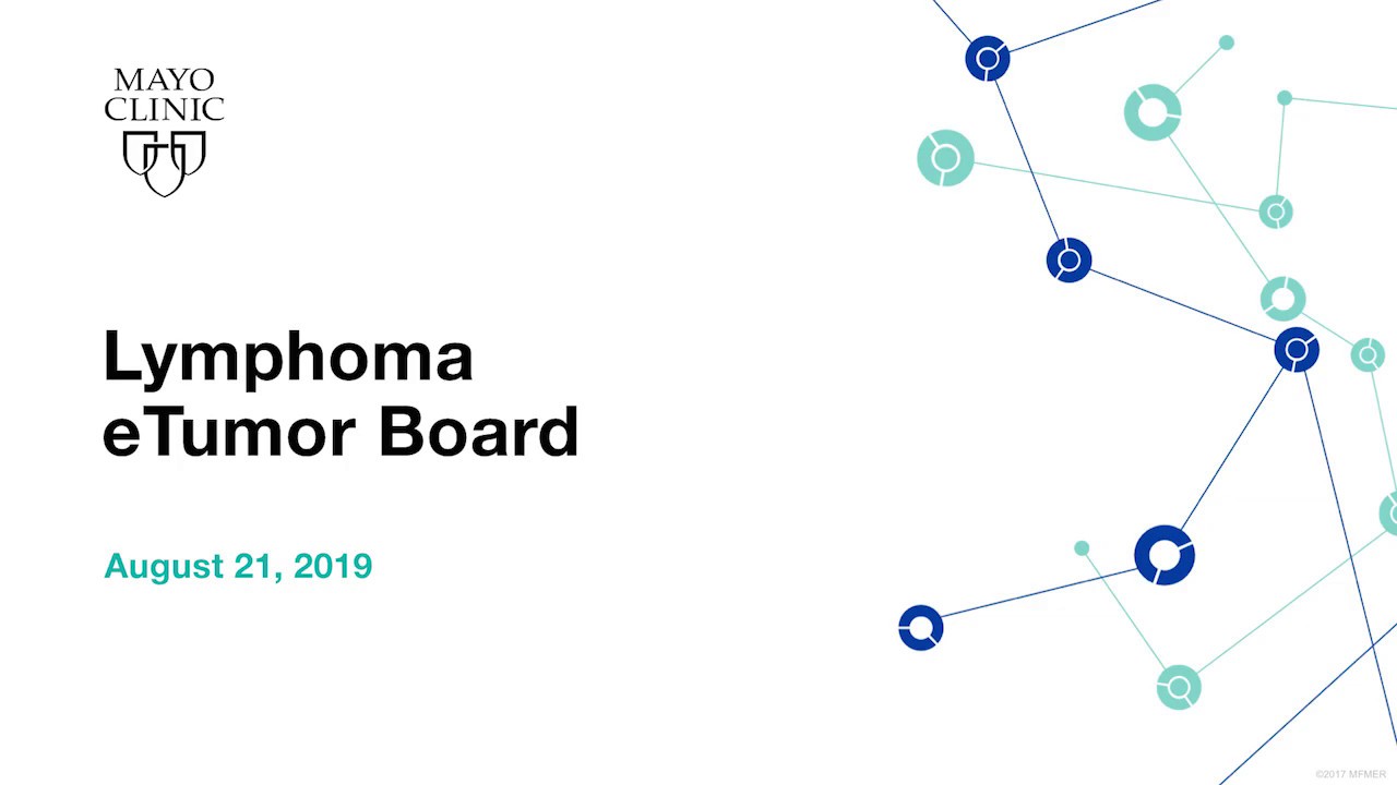 Mayo Clinic Lymphoma eTumor Board | Splenic marginal zone lymphoma with massive splenomegaly