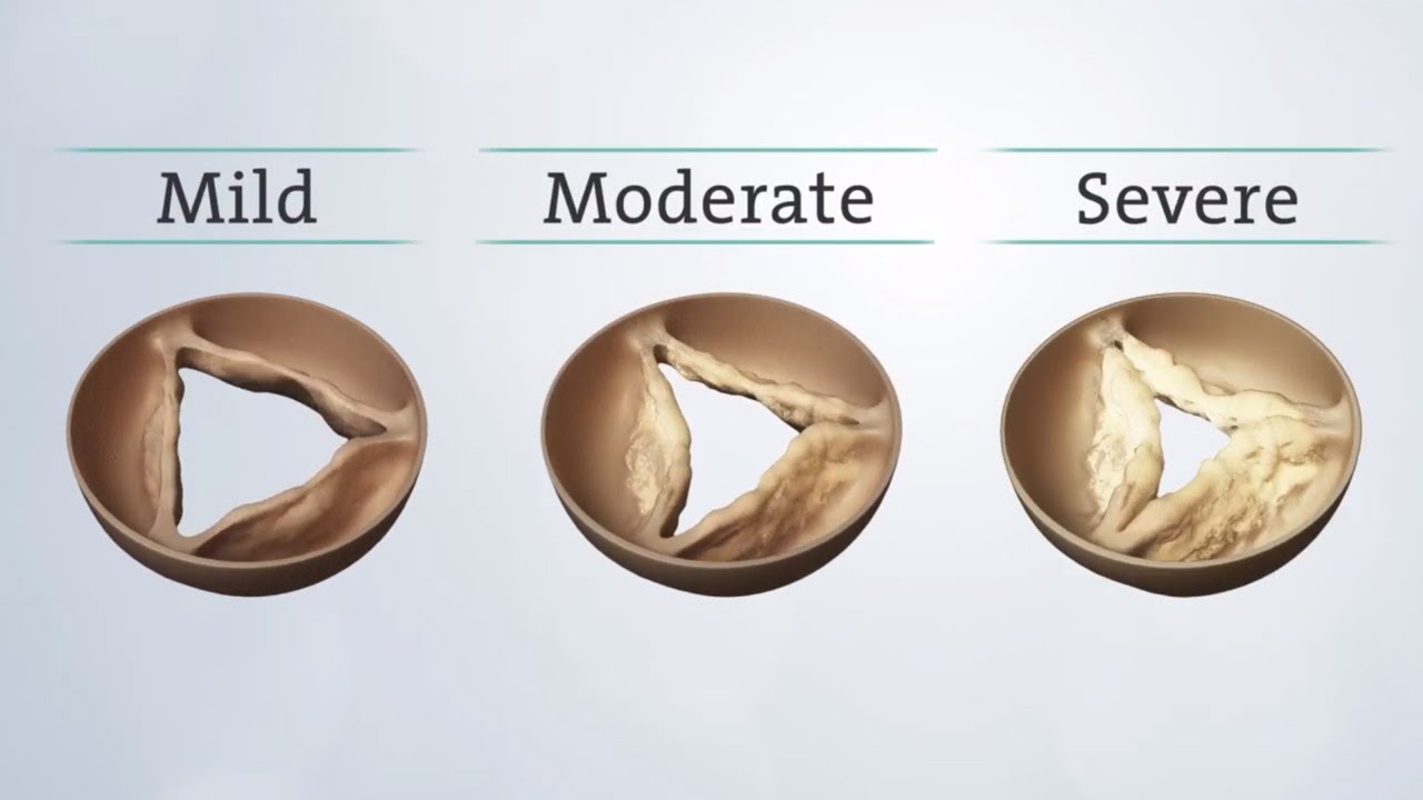 Understand Aortic Stenosis & Learn About TAVR