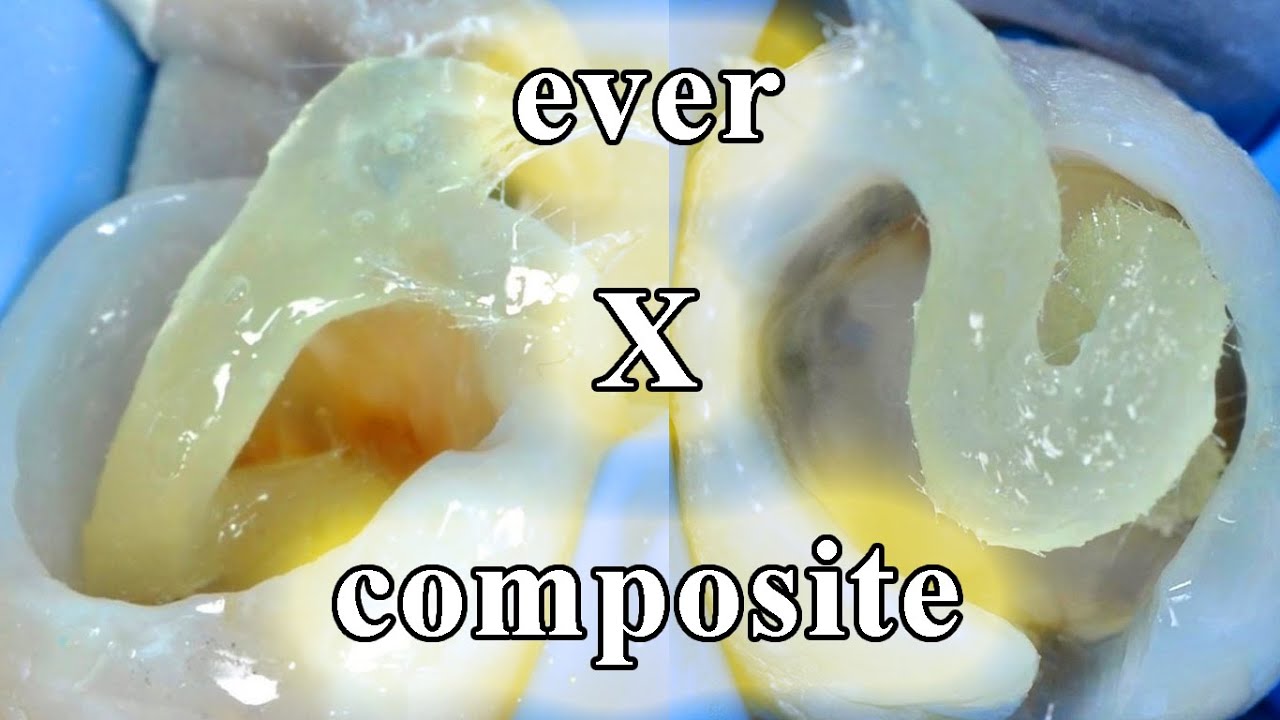 Ever x Composite | كومبوزت راح يعوض عن وجود الدنتين