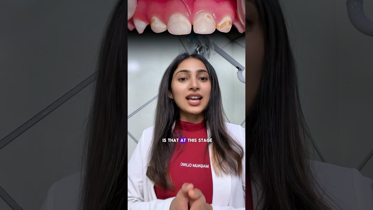 How to Remineralize White Spot Lesions & Prevent Cavities in Kids | Dental Care Tips 