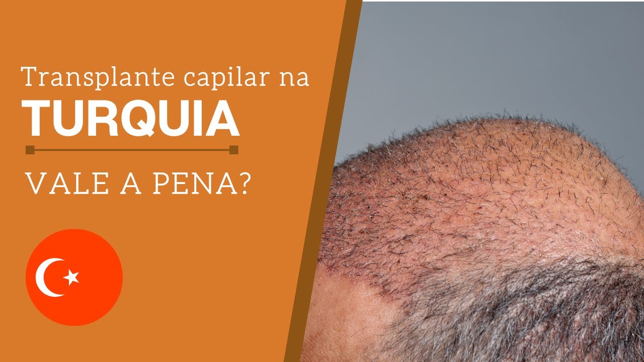 Transplante capilar na Turquia, vale a pena?