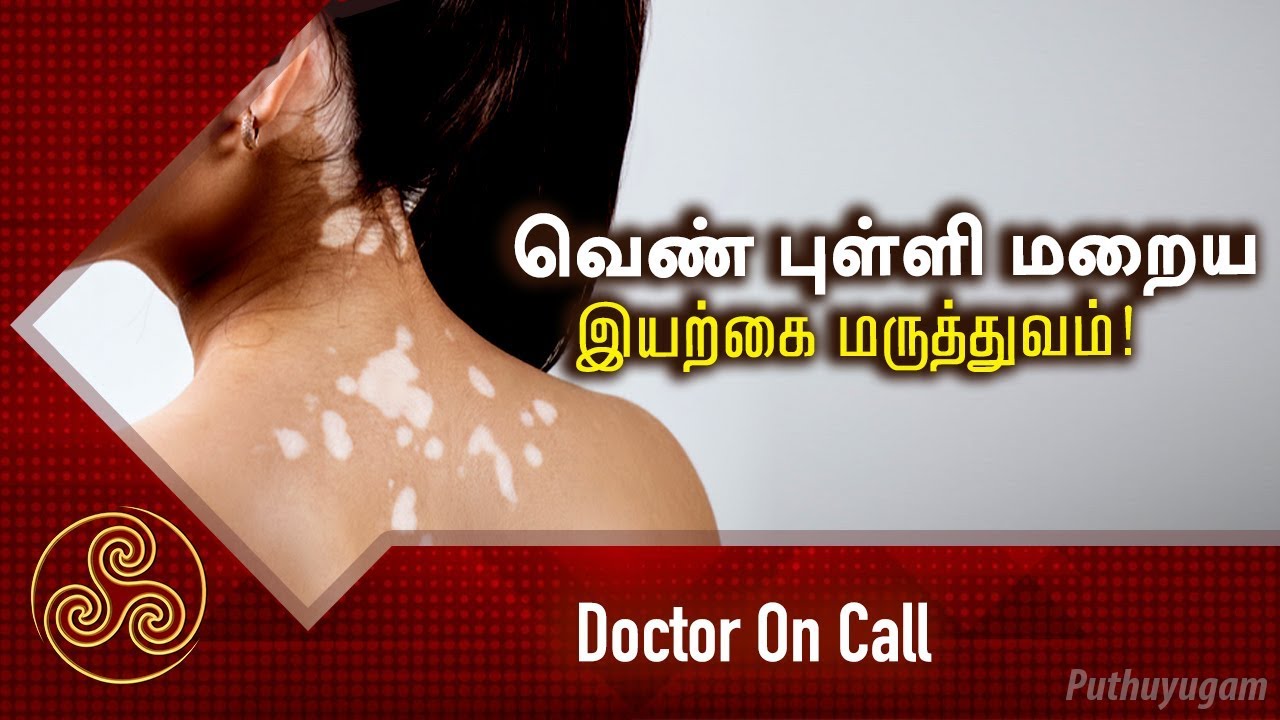 வெண் புள்ளி மறைய இயற்கை மருத்துவம்! Doctor On Call  | 26/03/2019