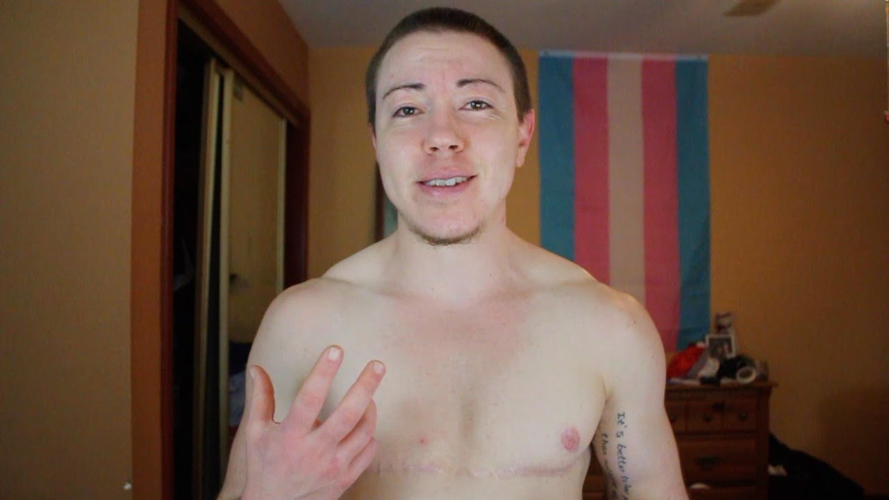 FTM One Year on Testosterone Changes
