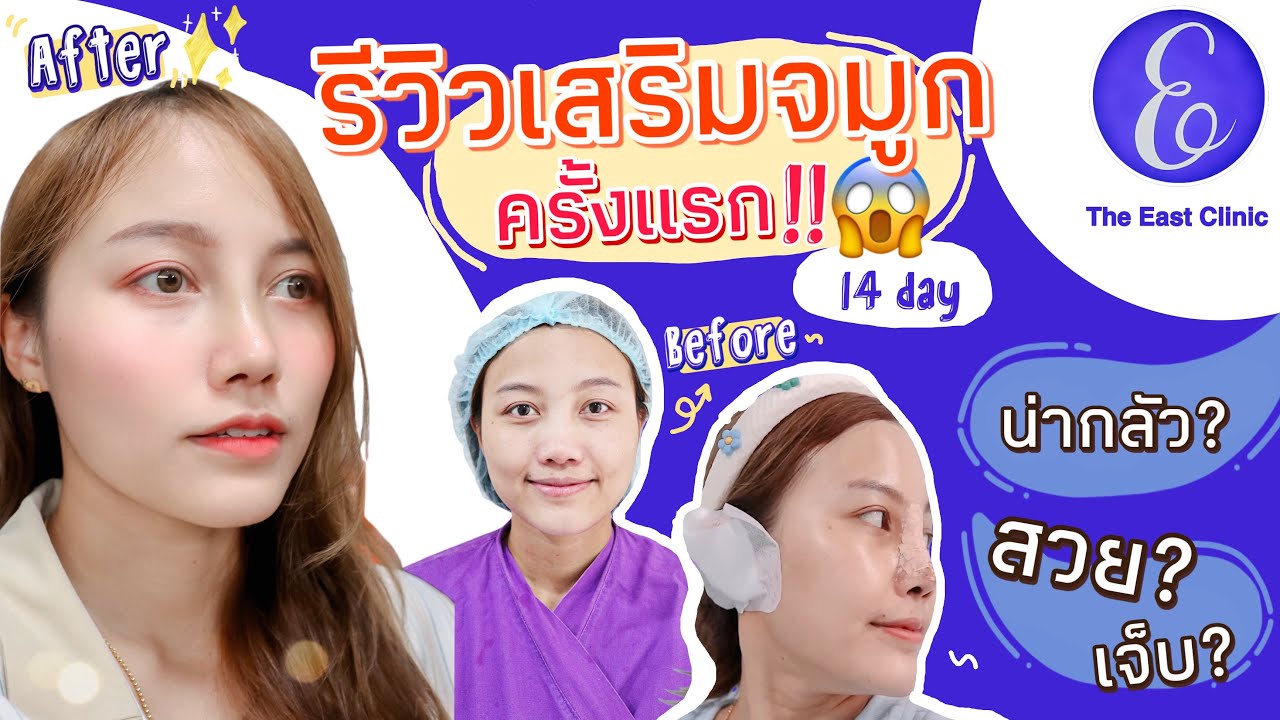 รีวิวเสริมจมูกครั้งแรก✨เกิดเหตุไม่คาดฝัน! 😱OMG | Minimai
