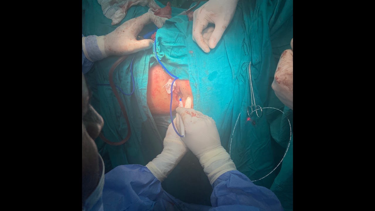 Prof. Reda Saad &ldquo; Minimally invasive esophagectomy
