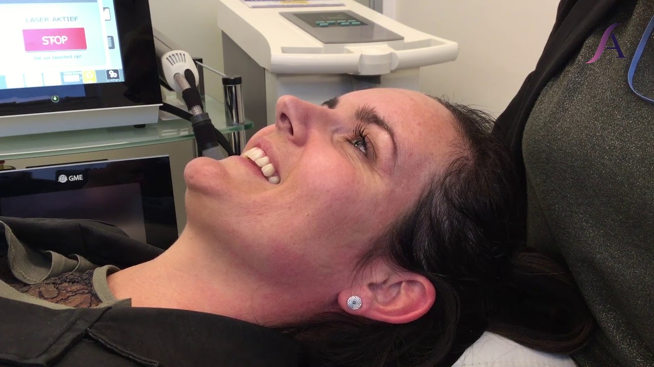 Fractional laser behandeling bij Acura Medisch Centrum