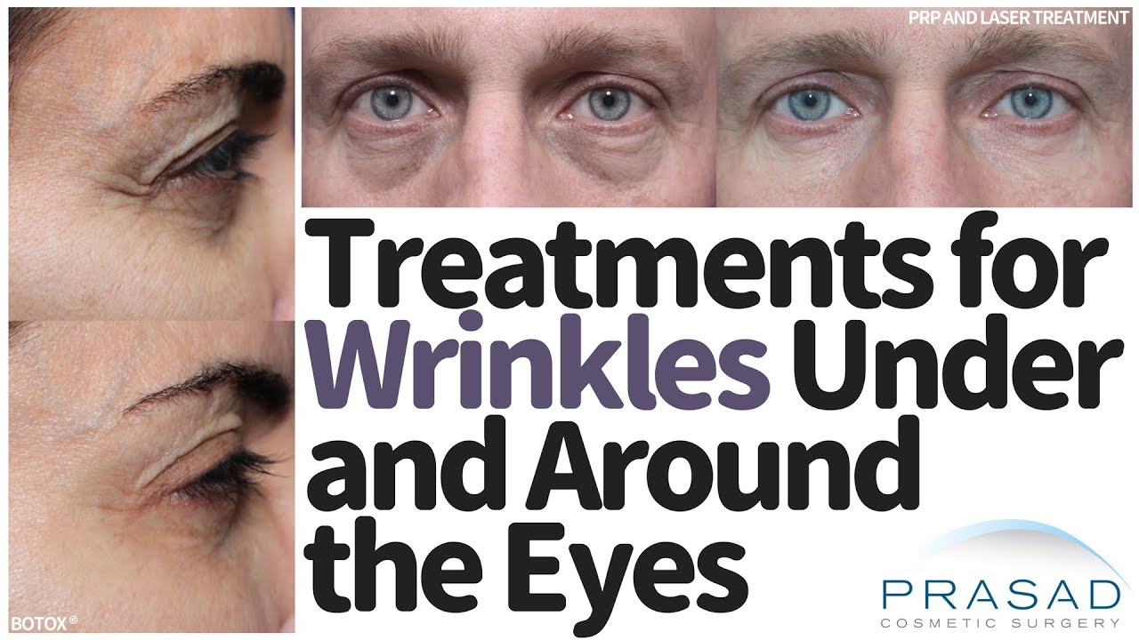 How to Treat Wrinkles Under and Around the Eyes