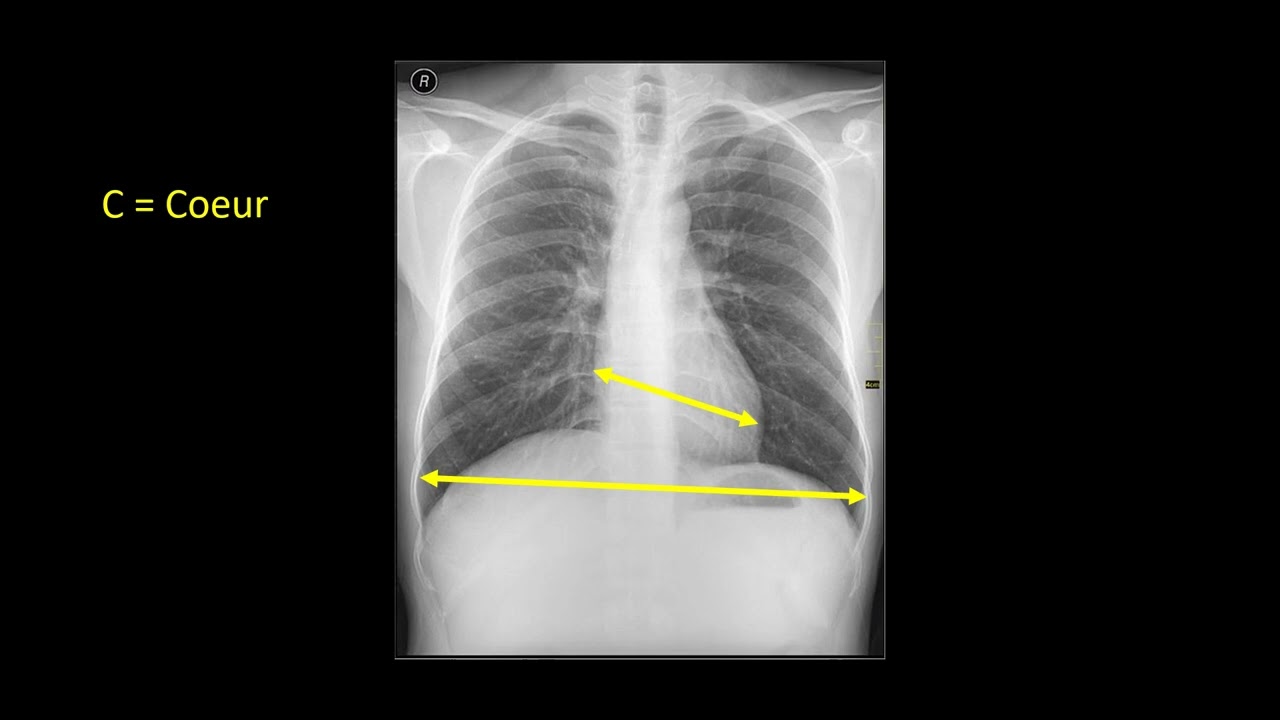Analyse systématique d'une radiographie du thorax