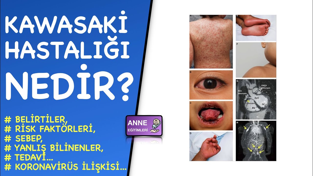 Kawasaki Hastalığı Nedir? (Belirtileri, Sebebi, Tedavisi, Koronavirüs İlişkisi)