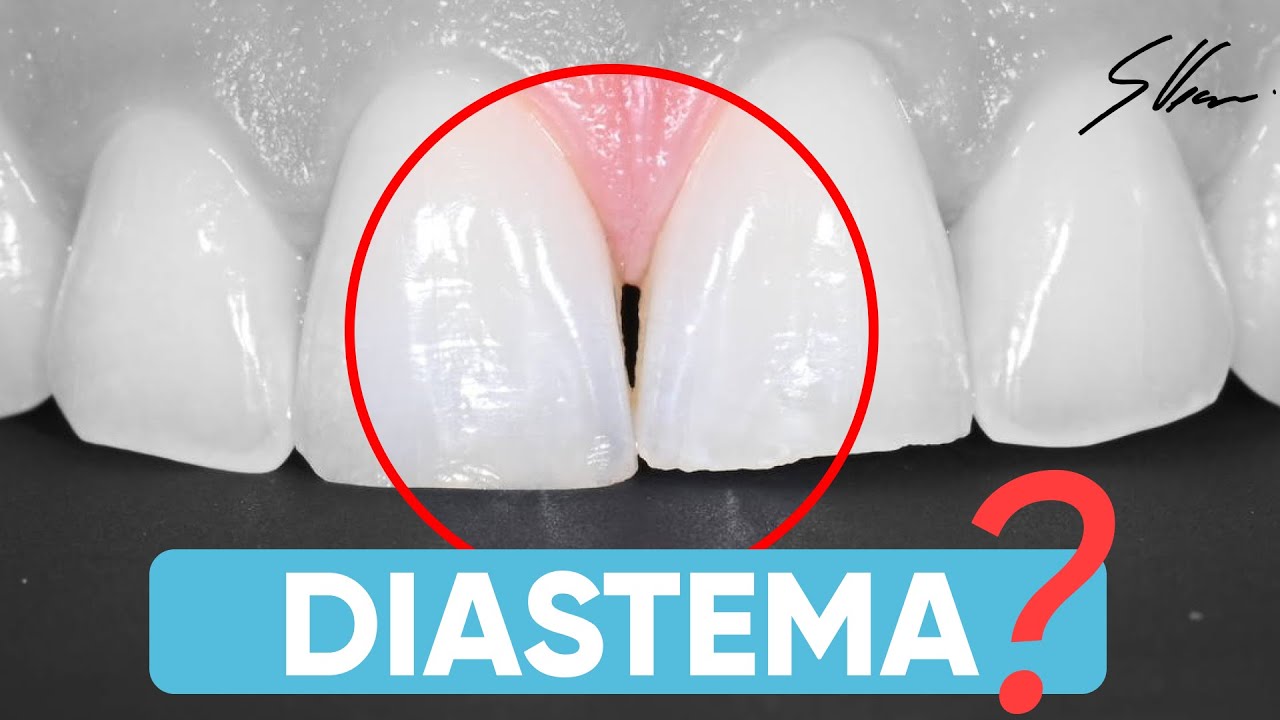 Hai uno spazio tra i denti? Potrebbe non essere un DIASTEMA