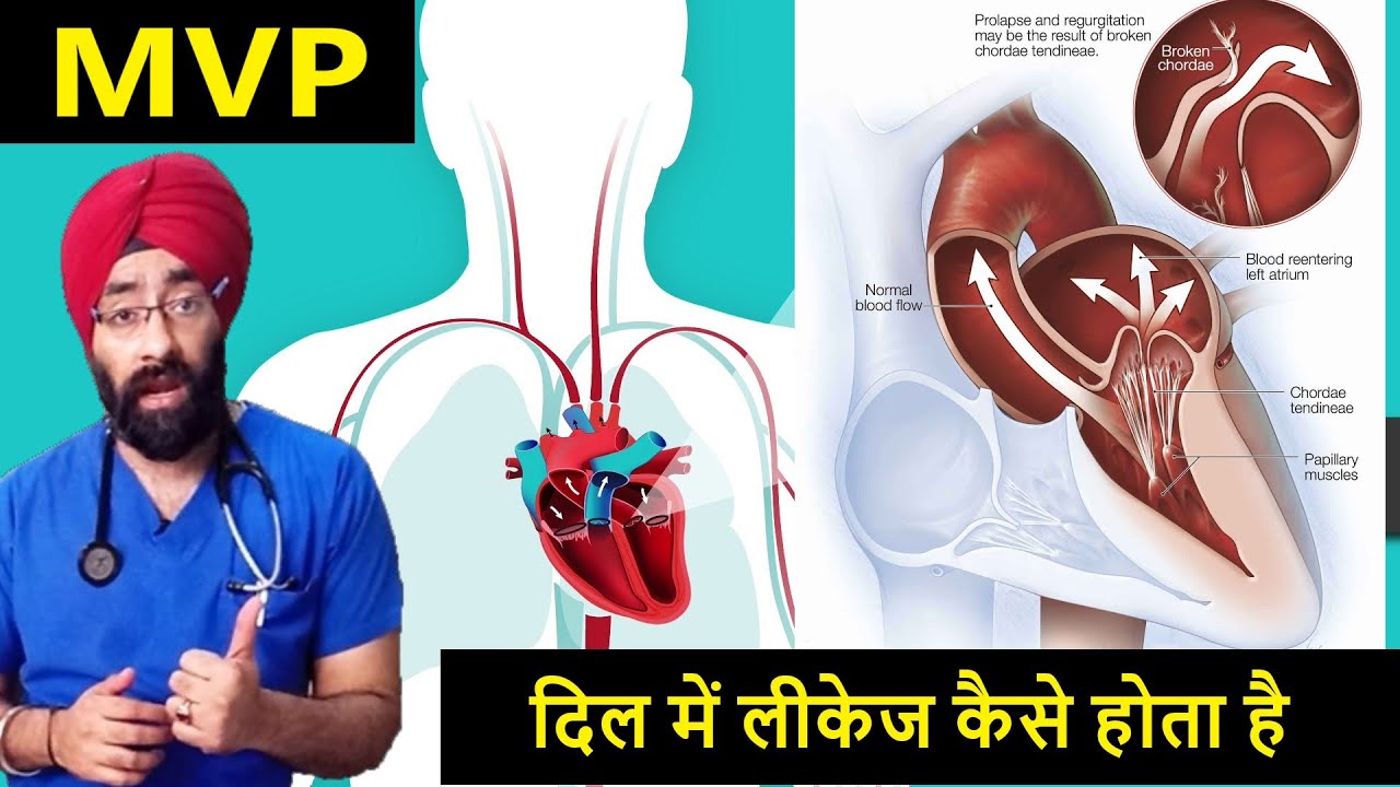 दिल में लीकेज | Leak in Heart | Mitral Valve Prolapse | MVP Regurgitation | Dr.Education