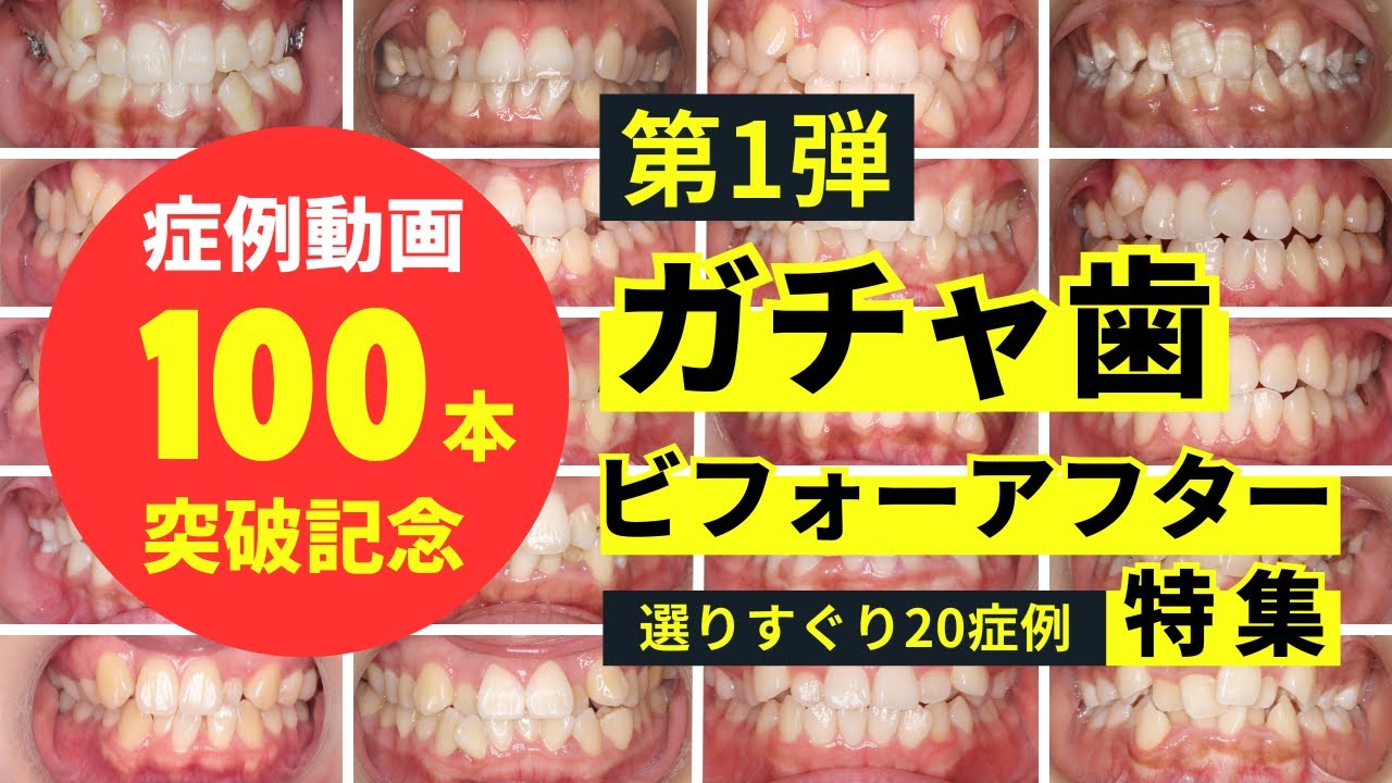 矯正症例動画100本突破記念第1弾｜ガチャ歯でお悩みの方へ｜ビフォーアフター特集