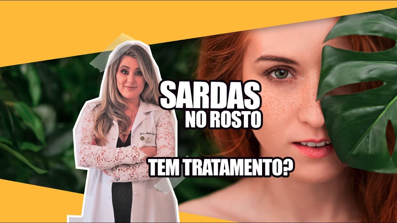 Sardas no rosto: Tem tratamento?